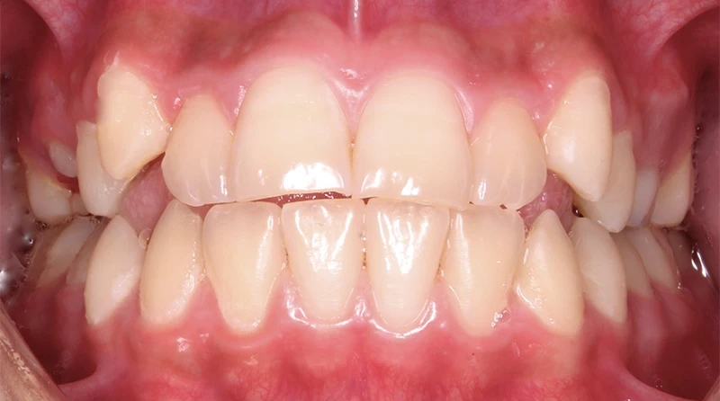 caso brackets