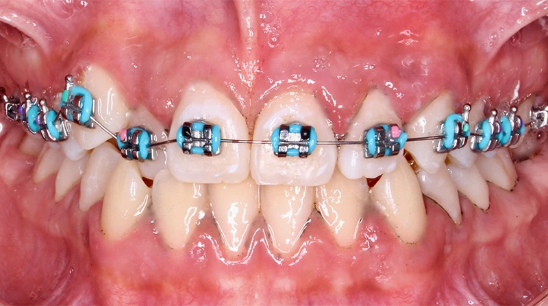 caso brackets