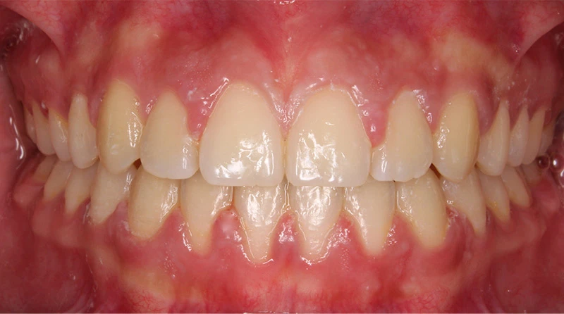 caso brackets