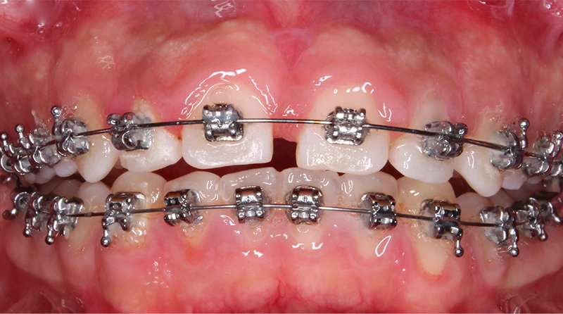 caso brackets